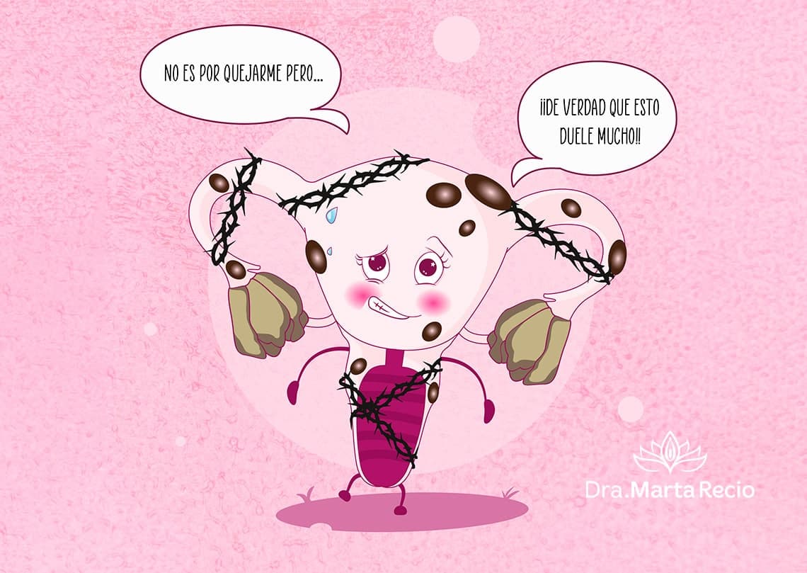 Ilustración de la endometriosis