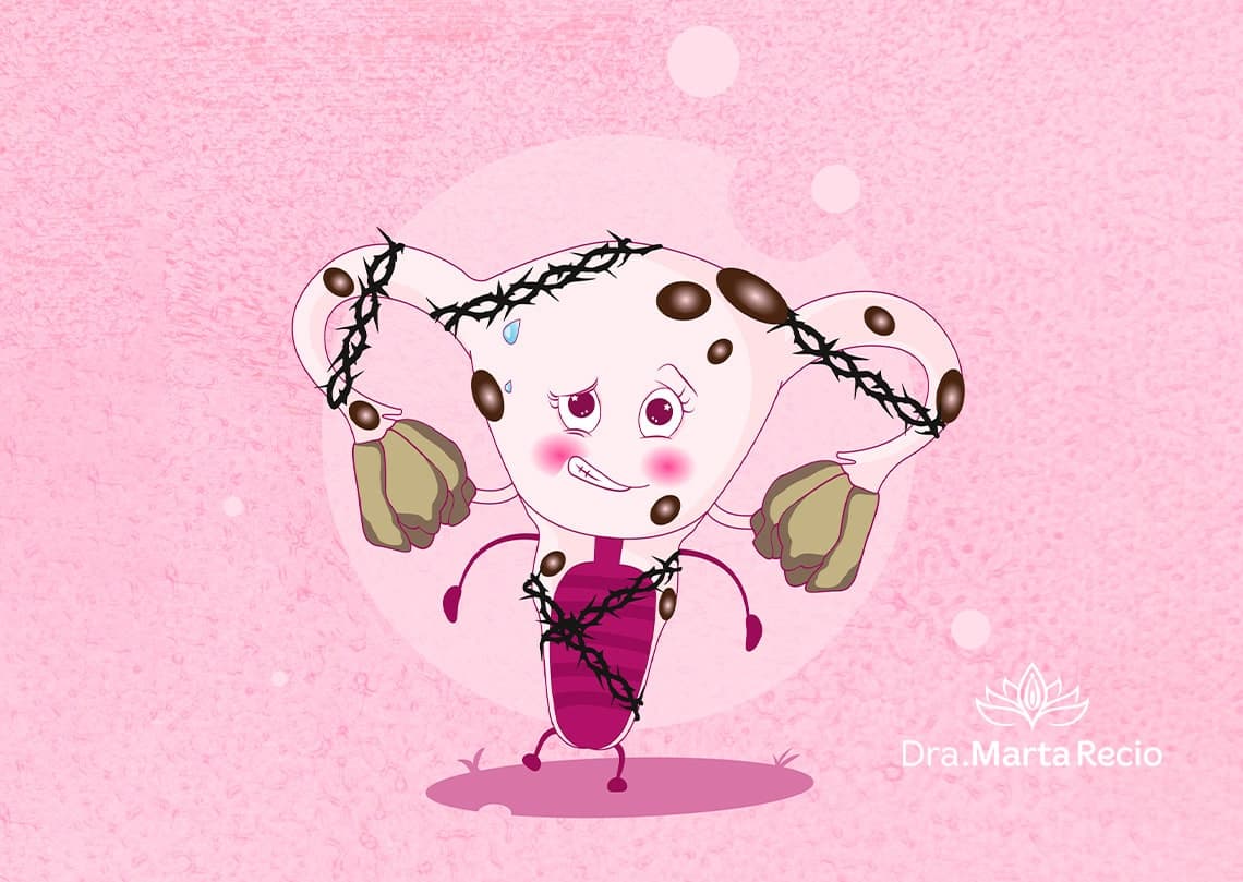 Ilustracion de la endometriosis